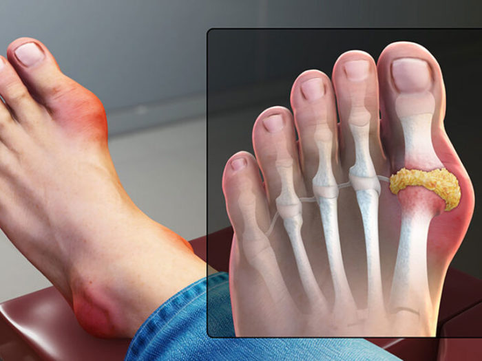 Típ 5 Bài thuốc ngâm chân chữa Bệnh Gout hiệu quả tại nhà